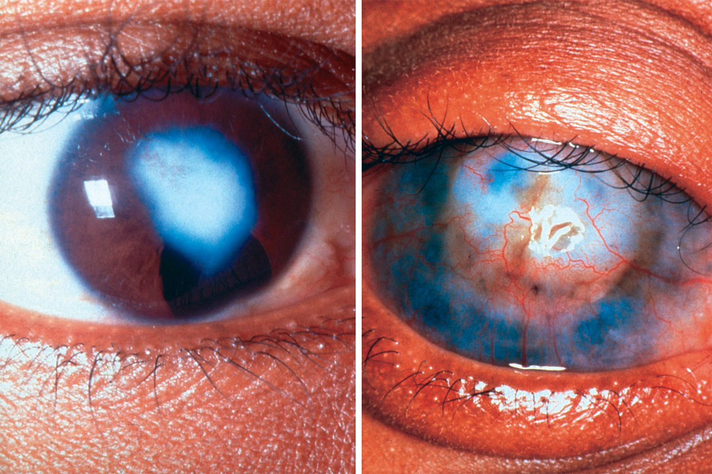 Comparison of healthy cornea vs corneal scarring